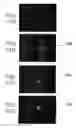 Fig. 17 - Therapy for lysosomal enzyme deficiencies