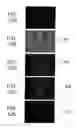 Fig. 18 - Therapy for lysosomal enzyme deficiencies