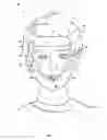 Fig. 02 - MANDIBULAR ADVANCEMENT