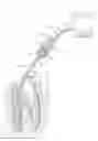 Fig. 01 - Endodontic procedure employing simultaneous liquefaction and acoustic debridement