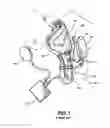 Fig. 02 - Method and apparatus for long-term assisting a left ventricle to pump blood