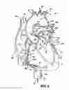 Fig. 03 - Method and apparatus for long-term assisting a left ventricle to pump blood