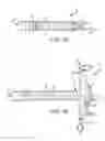 Fig. 02 - Apparatus and methods for supporting cardiac ischemic tissue