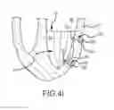 Fig. 08 - Apparatus and methods for supporting cardiac ischemic tissue