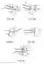 Fig. 09 - Apparatus and methods for supporting cardiac ischemic tissue