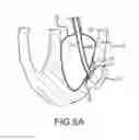 Fig. 10 - Apparatus and methods for supporting cardiac ischemic tissue
