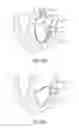 Fig. 11 - Apparatus and methods for supporting cardiac ischemic tissue