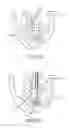 Fig. 14 - Apparatus and methods for supporting cardiac ischemic tissue