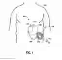 Fig. 02 - IMPLANTABLE ACCESS PORT SYSTEM