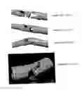 Fig. 02 - TWO-PART ENDOSCOPE SURGICAL DEVICE
