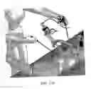 Fig. 35 - TWO-PART ENDOSCOPE SURGICAL DEVICE