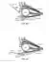 Fig. 25 - Retrobulbar syringe including soft cannula distal end