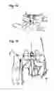 Fig. 17 - Catheter anchoring system, apparatus and method