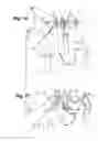 Fig. 18 - Catheter anchoring system, apparatus and method