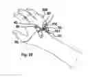 Fig. 27 - Catheter anchoring system, apparatus and method
