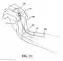 Fig. 12 - Intraluminal cannula placement apparatus utilizing a specialized cannula for use with a previously inserted I.V. catheter