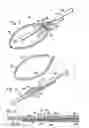 Fig. 04 - CABLE TIE SYSTEM FOR STABILIZING BONE