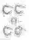 Fig. 03 - GASTRIC RING WITH FACETS