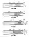 Fig. 04 - Method and apparatus for increasing blood flow through an obstructed blood vessel