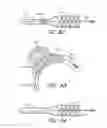 Fig. 70 - THROMBUS MANAGEMENT SYSTEM