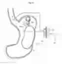 Fig. 19 - Obesity treatment