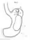 Fig. 20 - Obesity treatment