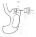 Fig. 22 - Obesity treatment