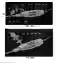Fig. 11 - DEVICES AND METHODS FOR TREATING GASTROINTESTINAL AND METABOLIC DISORDERS