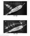 Fig. 12 - DEVICES AND METHODS FOR TREATING GASTROINTESTINAL AND METABOLIC DISORDERS