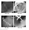 Fig. 13 - DEVICES AND METHODS FOR TREATING GASTROINTESTINAL AND METABOLIC DISORDERS