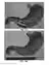 Fig. 18 - DEVICES AND METHODS FOR TREATING GASTROINTESTINAL AND METABOLIC DISORDERS