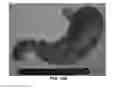 Fig. 19 - DEVICES AND METHODS FOR TREATING GASTROINTESTINAL AND METABOLIC DISORDERS