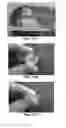 Fig. 22 - DEVICES AND METHODS FOR TREATING GASTROINTESTINAL AND METABOLIC DISORDERS