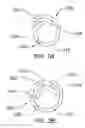 Fig. 03 - Expandable spinal sheath and method of use