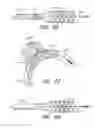 Fig. 70 - THROMBUS MANAGEMENT DEVICE