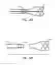 Fig. 71 - THROMBUS MANAGEMENT DEVICE