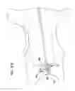 Fig. 46 - MEDICAL DEVICE AND PROCEDURE FOR ATTACHING TISSUE TO BONE