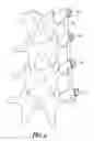 Fig. 07 - VARIABLE OFFSET SPINE FIXATION SYSTEM AND METHOD
