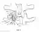 Fig. 06 - Vertebral implant