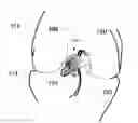 Fig. 01 - Swivel Screw Ligament Fixation Device