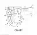 Fig. 06 - Endocardial pacing devices and methods useful for resynchronization and defibrillation