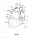 Fig. 03 - Transcoronary sinus pacing system, LV summit pacing, early mitral closure pacing, and methods therefor