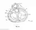 Fig. 04 - Transcoronary sinus pacing system, LV summit pacing, early mitral closure pacing, and methods therefor