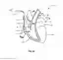 Fig. 13 - Transcoronary sinus pacing system, LV summit pacing, early mitral closure pacing, and methods therefor