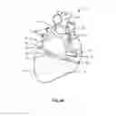 Fig. 16 - Transcoronary sinus pacing system, LV summit pacing, early mitral closure pacing, and methods therefor