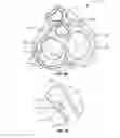 Fig. 17 - Transcoronary sinus pacing system, LV summit pacing, early mitral closure pacing, and methods therefor