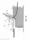 Fig. 17 - STENT GRAFT FENESTRATION
