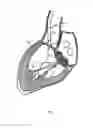 Fig. 07 - Methods and Apparatus for Endovascular Heart Valve Replacement Comprising Tissue Grasping Elements