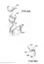 Fig. 52 - PROSTHETIC VALVE FOR CATHETER DELIVERY