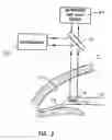 Fig. 03 - Implantable devices and methods for measuring intraocular, subconjunctival or subdermal pressure and/or analyte concentration